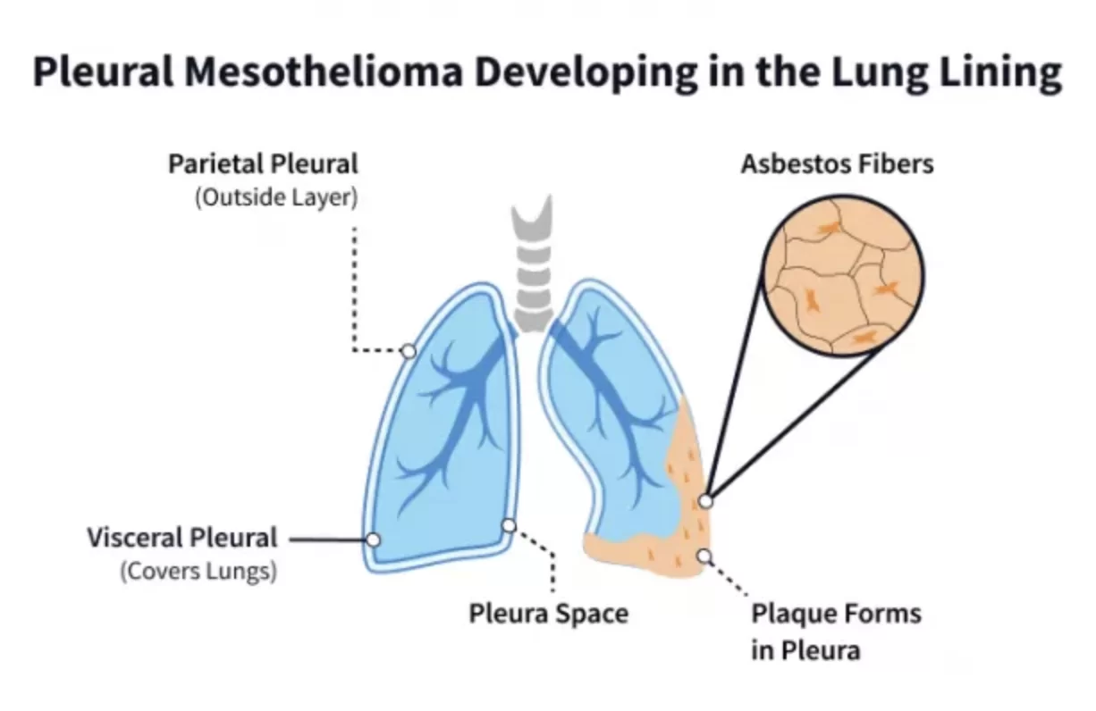 Understanding Mesothelioma: What are the Causes, Symptoms, and Treatment Options?
